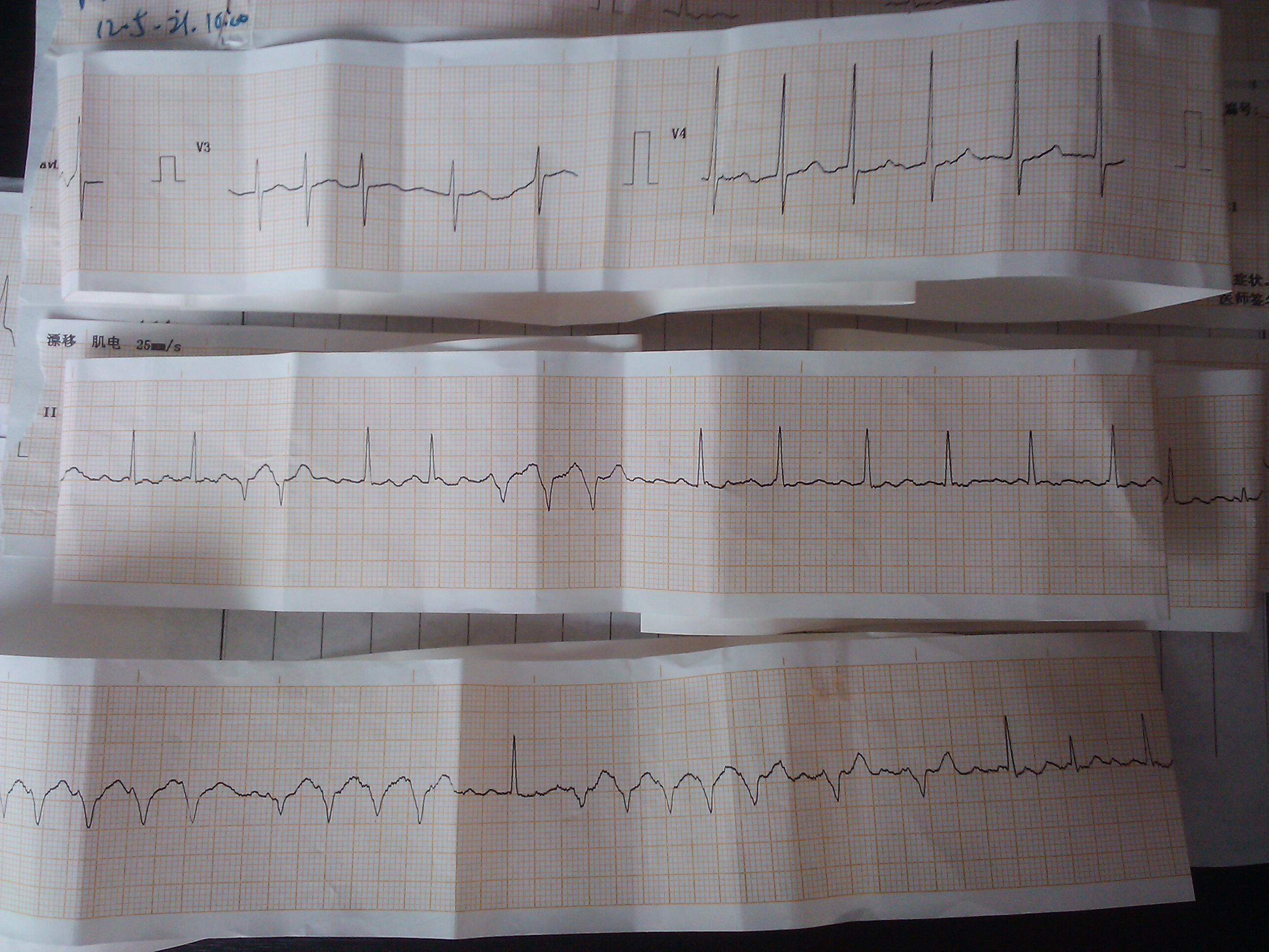 新收的病人心电图分析,请教高手