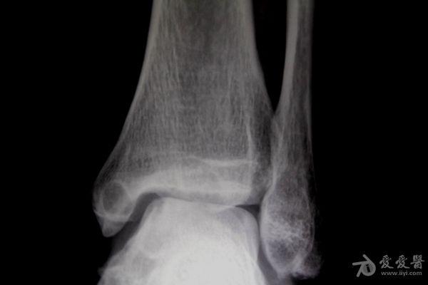 左踝关节肿痛2年. - 骨科与显微外科专业讨论版
