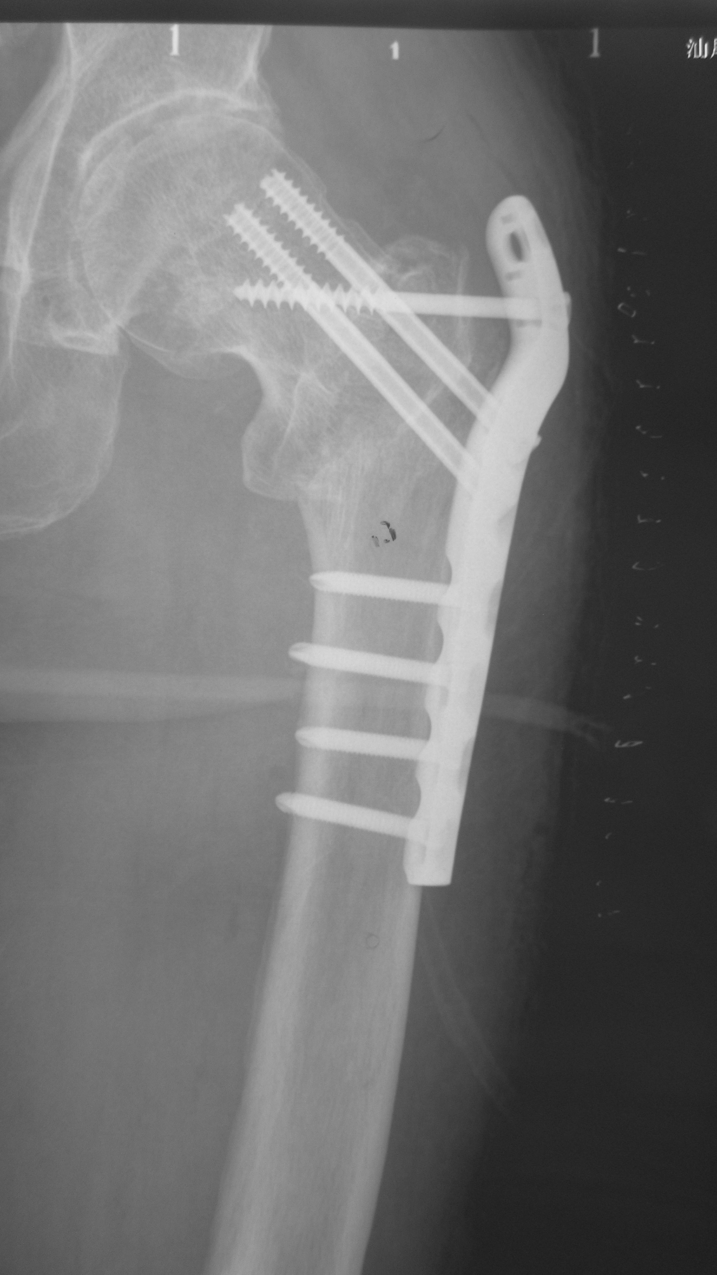 转子间骨折股骨近端锁定钢板固定失败
