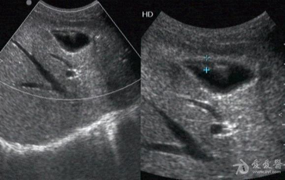 胆囊腺肌症? - 超声医学讨论版 - 爱爱医医学论坛