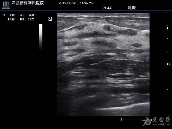 典型乳腺增生