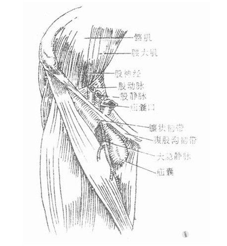 腹股沟包块(答案在21楼)