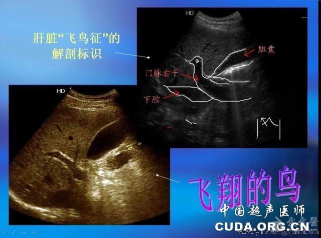 【转】肝脏里的"动物世界""