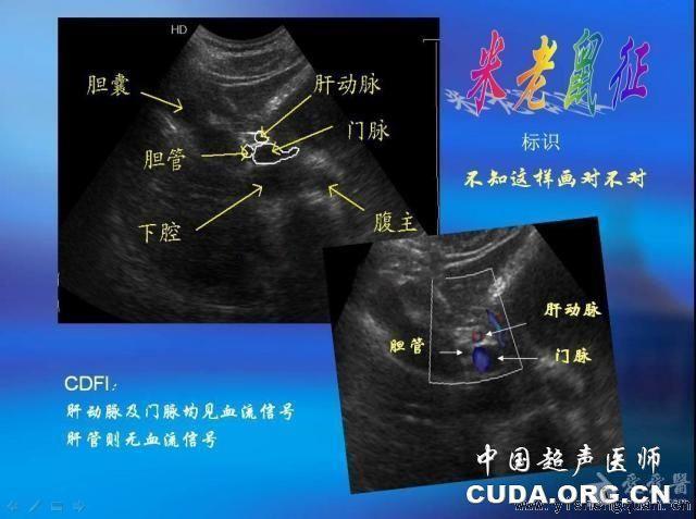 【转】肝脏里的"动物世界""