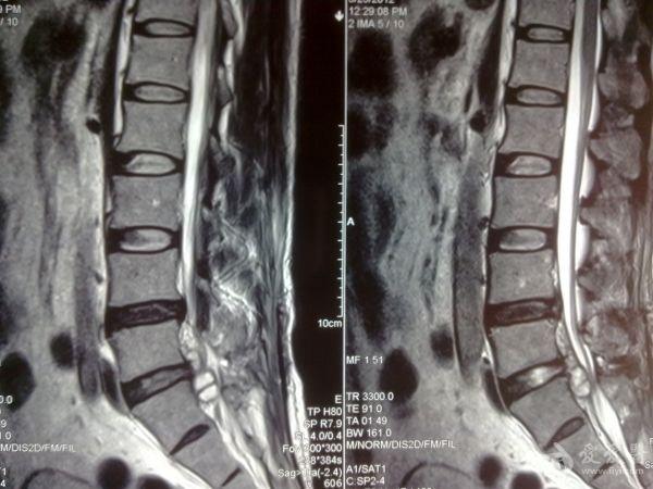l5s1椎间盘脱出髓核摘除术后疼痛