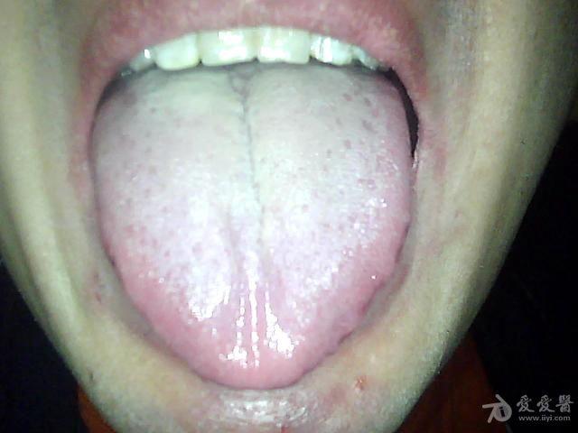 上热下寒病例