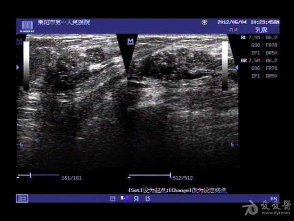 乳腺癌伴腋窝淋巴结转移 超声医学讨论版 爱爱医医学论坛 爱爱