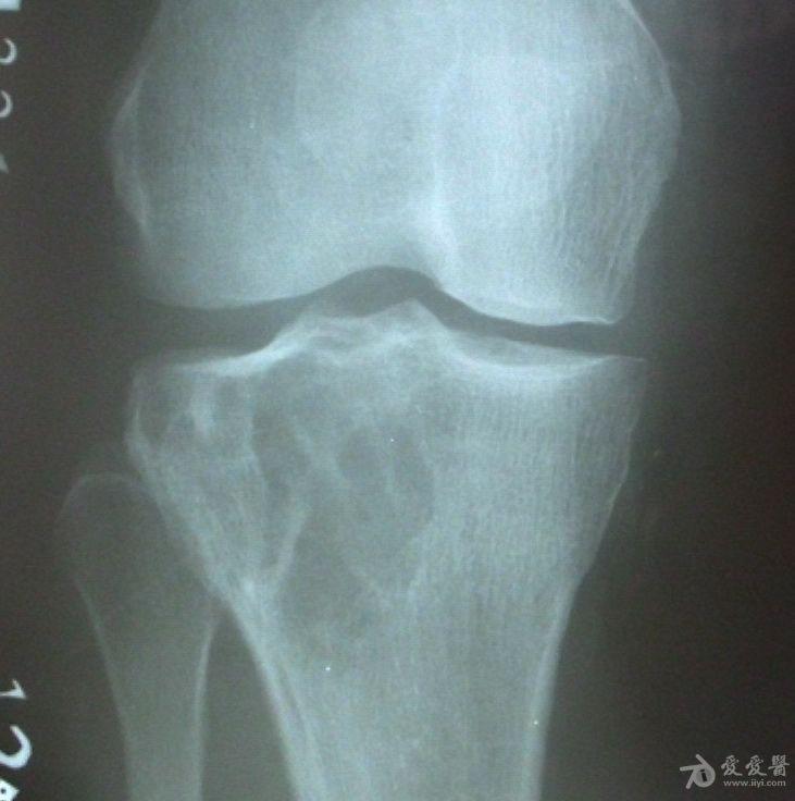 各位高手请帮忙看下一张膝关节平片