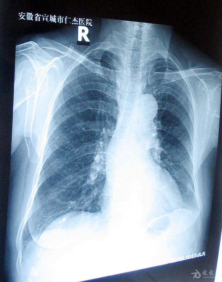 请帮张肺部x片,如图:谢谢!