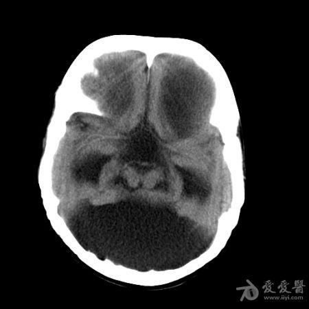 颅骨x线检查可有颅骨变薄,骨缝分离,蝶鞍扩大,前后床突骨质吸收,颅后