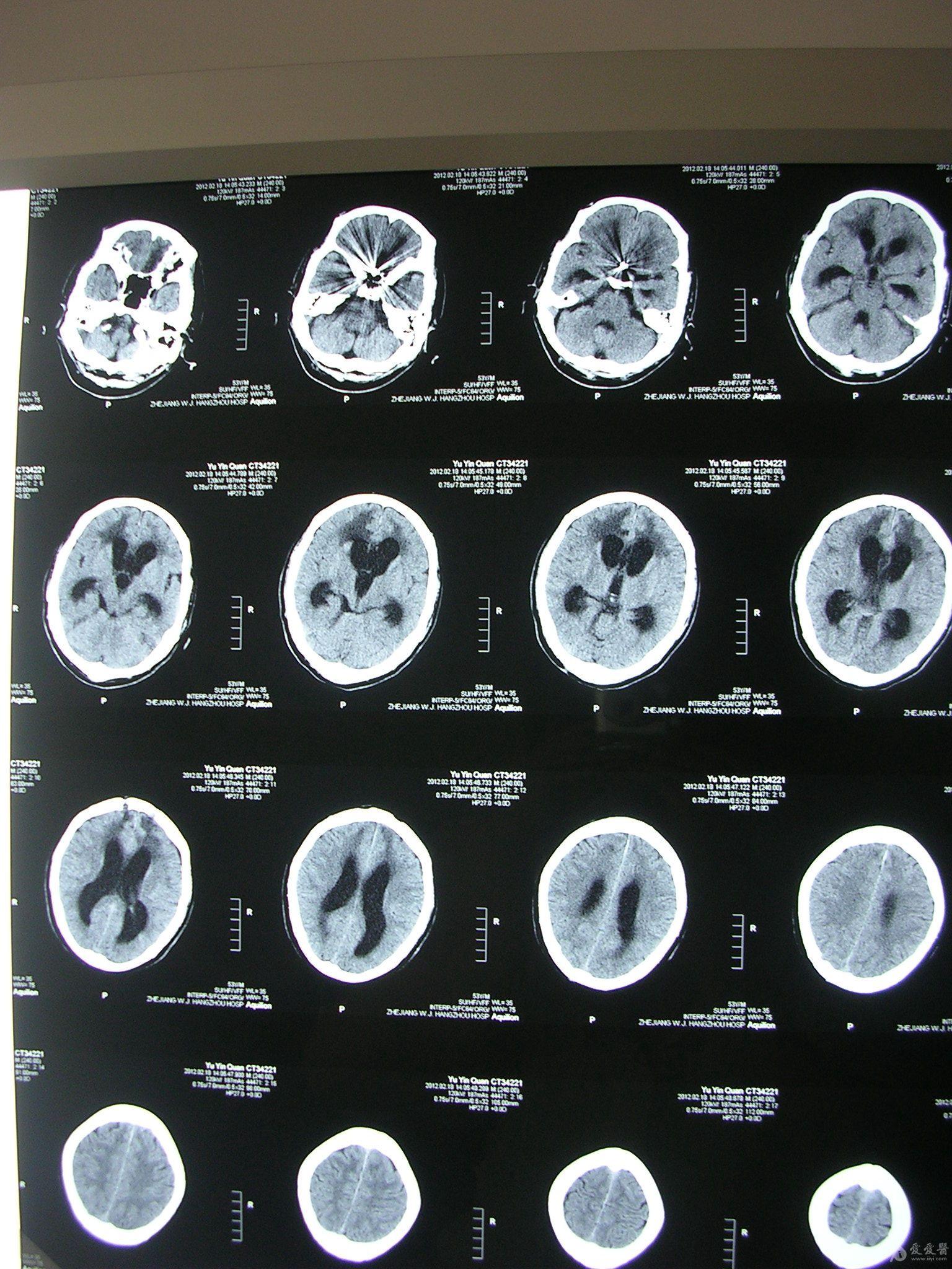 但是从头颅ct片上看患者脑室扩大明显,间质性脑水肿明显,应该有指征.
