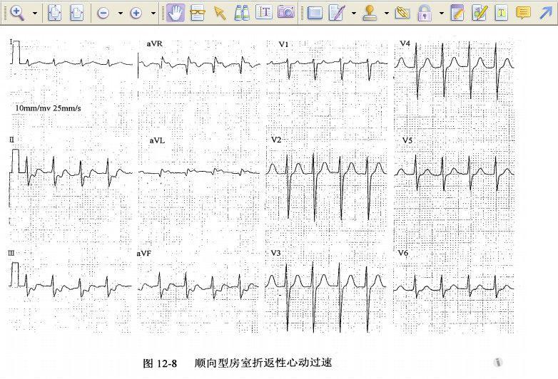 心电图宝典 第三部【pdf】