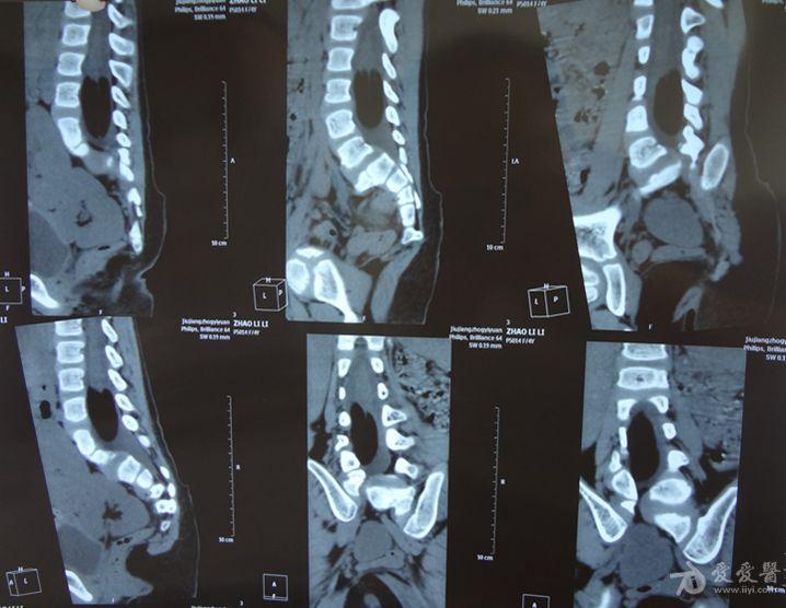 昨天门诊看了一位患儿,4岁的小女孩,查了胸腰椎x线片和腰椎ct