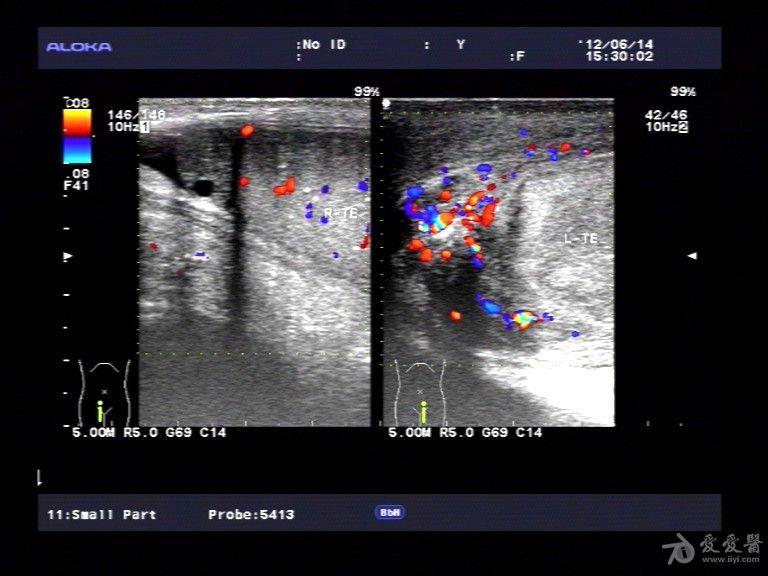 附睾炎 睾丸微石症一例. - 超声医学讨论版 - 爱爱医