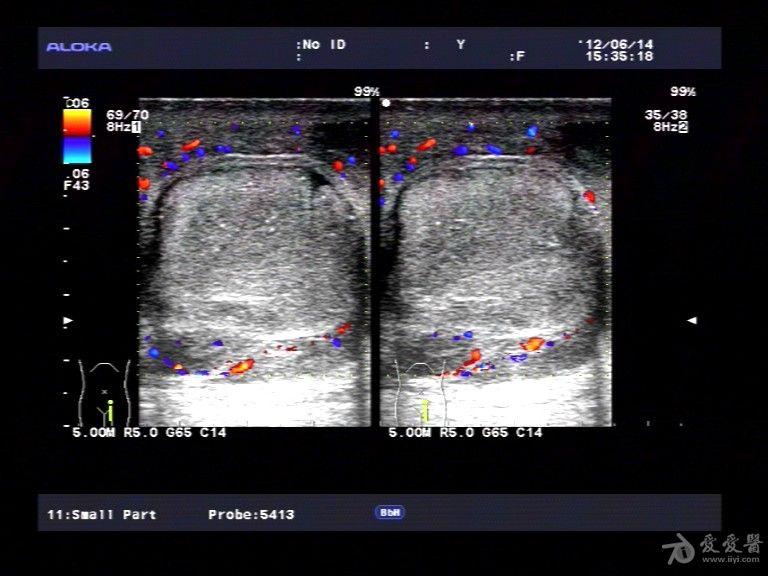 附睾炎 睾丸微石症一例. - 超声医学讨论版 - 爱爱医