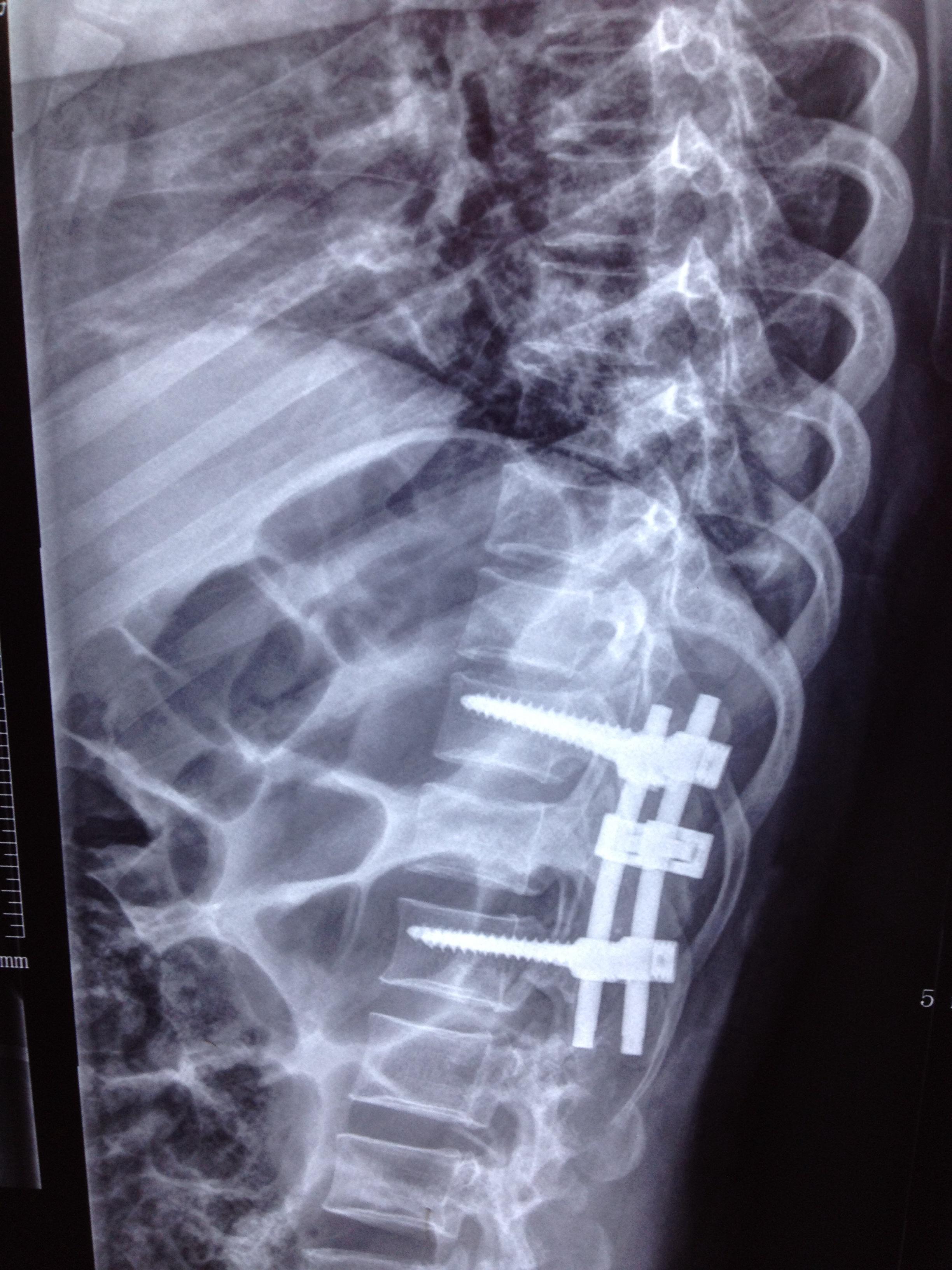 t12椎体爆裂性骨折伴不全瘫,没有减压,看效果