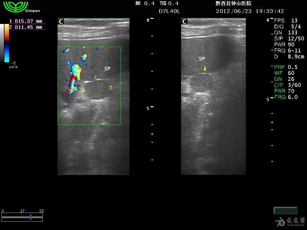 副脾- 超声医学讨论版 - 爱爱医医学论坛 - 爱爱医