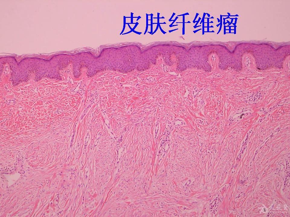 常见病理切片 - 基础病理讨论版 - 爱爱医医学论坛-爱爱医医学网