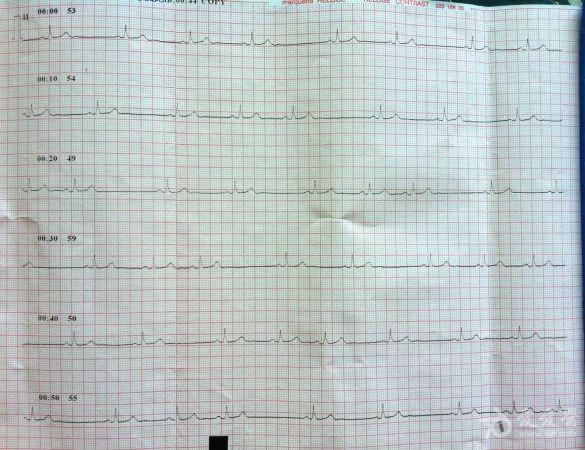 楼主秋土2012-06-29 17:36:28男,56岁,一个多月前体检发现心律失常,前