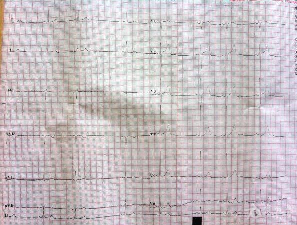 楼主秋土2012-06-29 17:36:28男,56岁,一个多月前体检发现心律失常,前