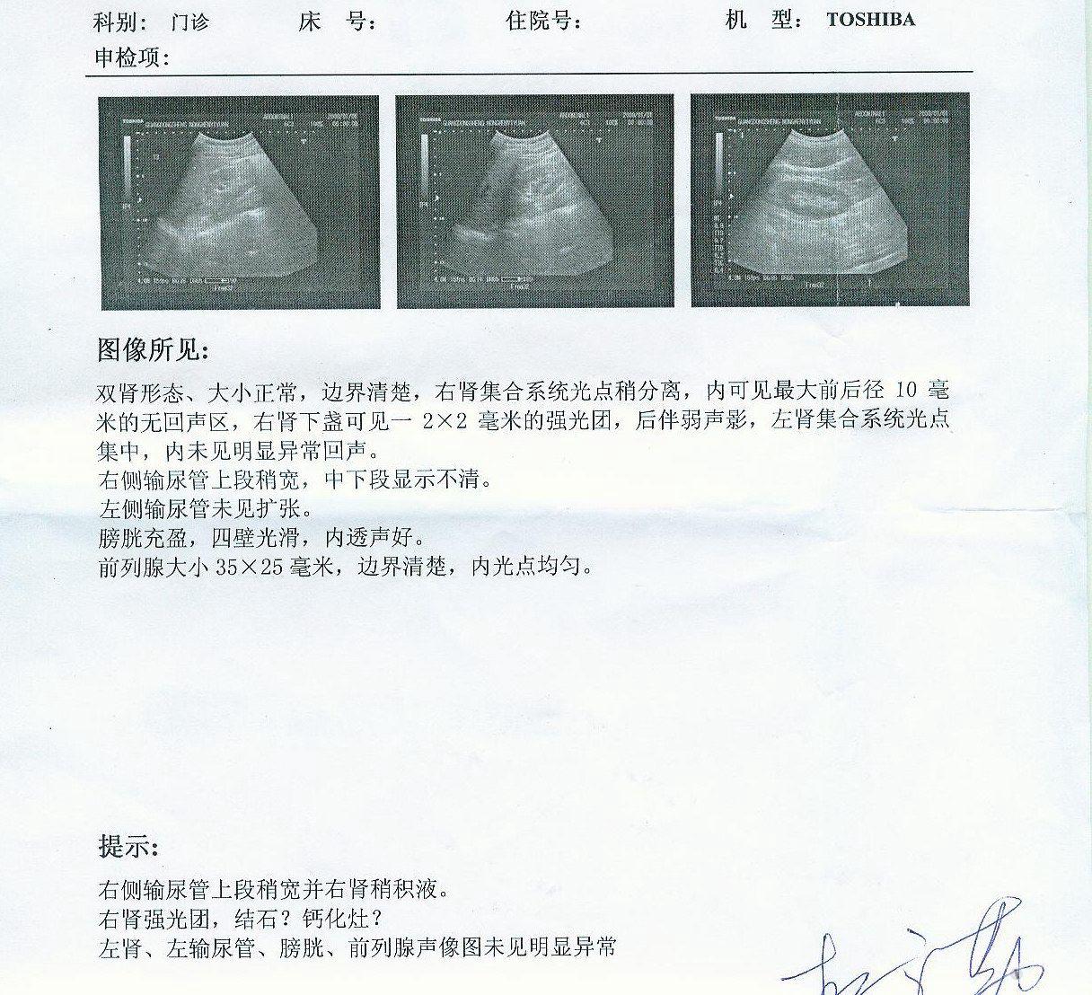 肾结石哪去了?