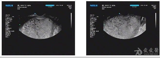 子宫内膜异位症的图片