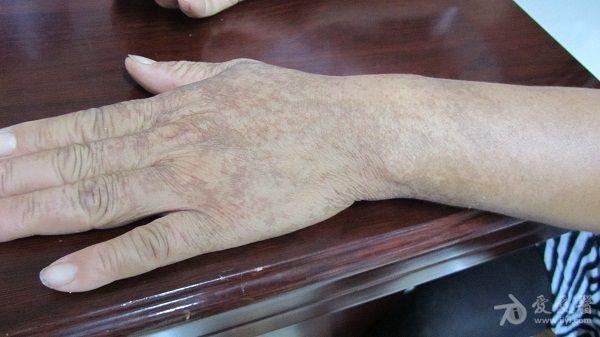发现双手及上肢褐色斑块3年余,无症状.既往体健.