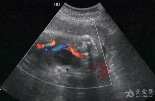 膀胱区横切,于膀胱右侧可见两彩色血流带,多普勒测得其一为动脉,一为