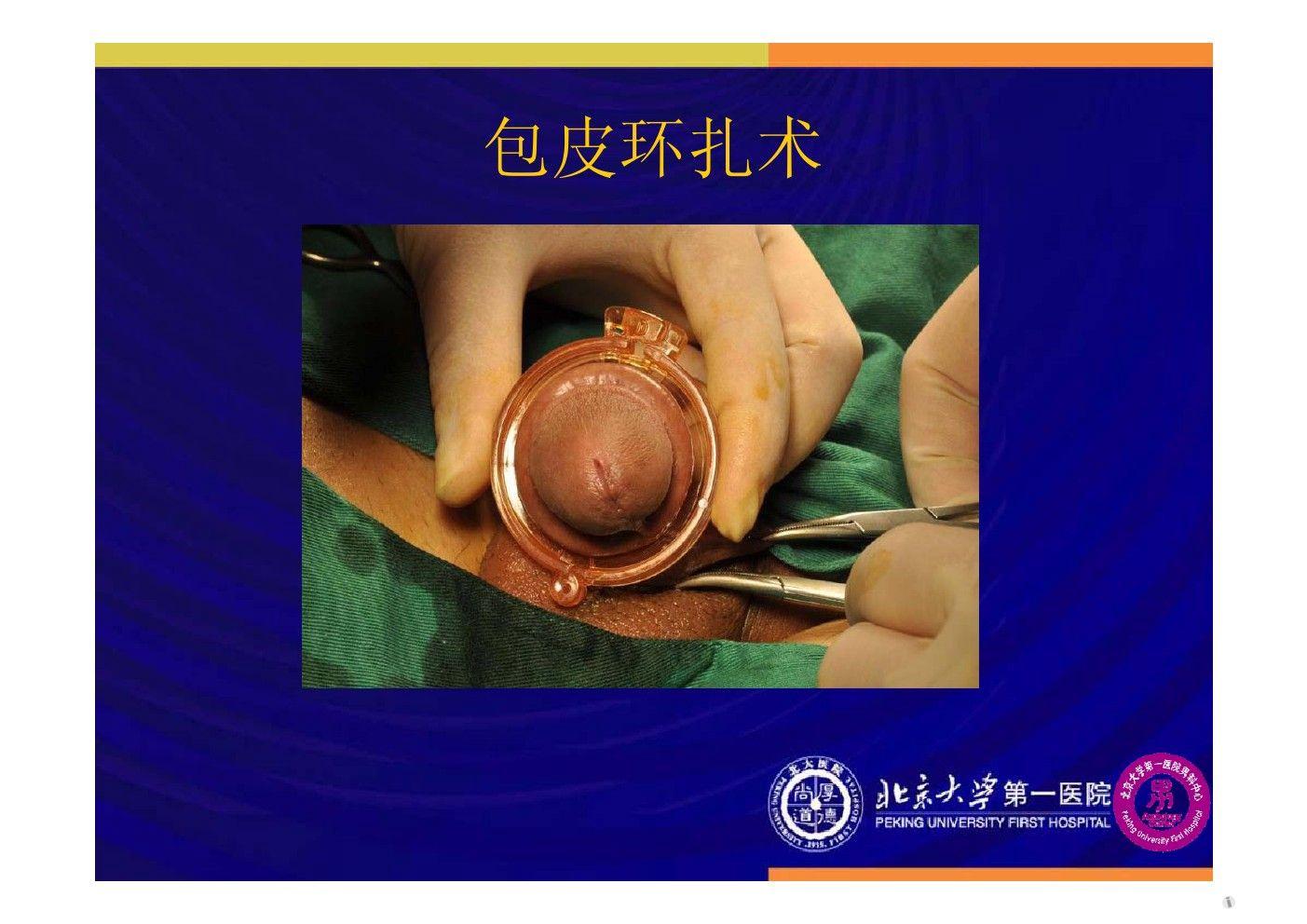 2012北京男科论坛(十六—袁亦铭-男科手术的现状与治疗