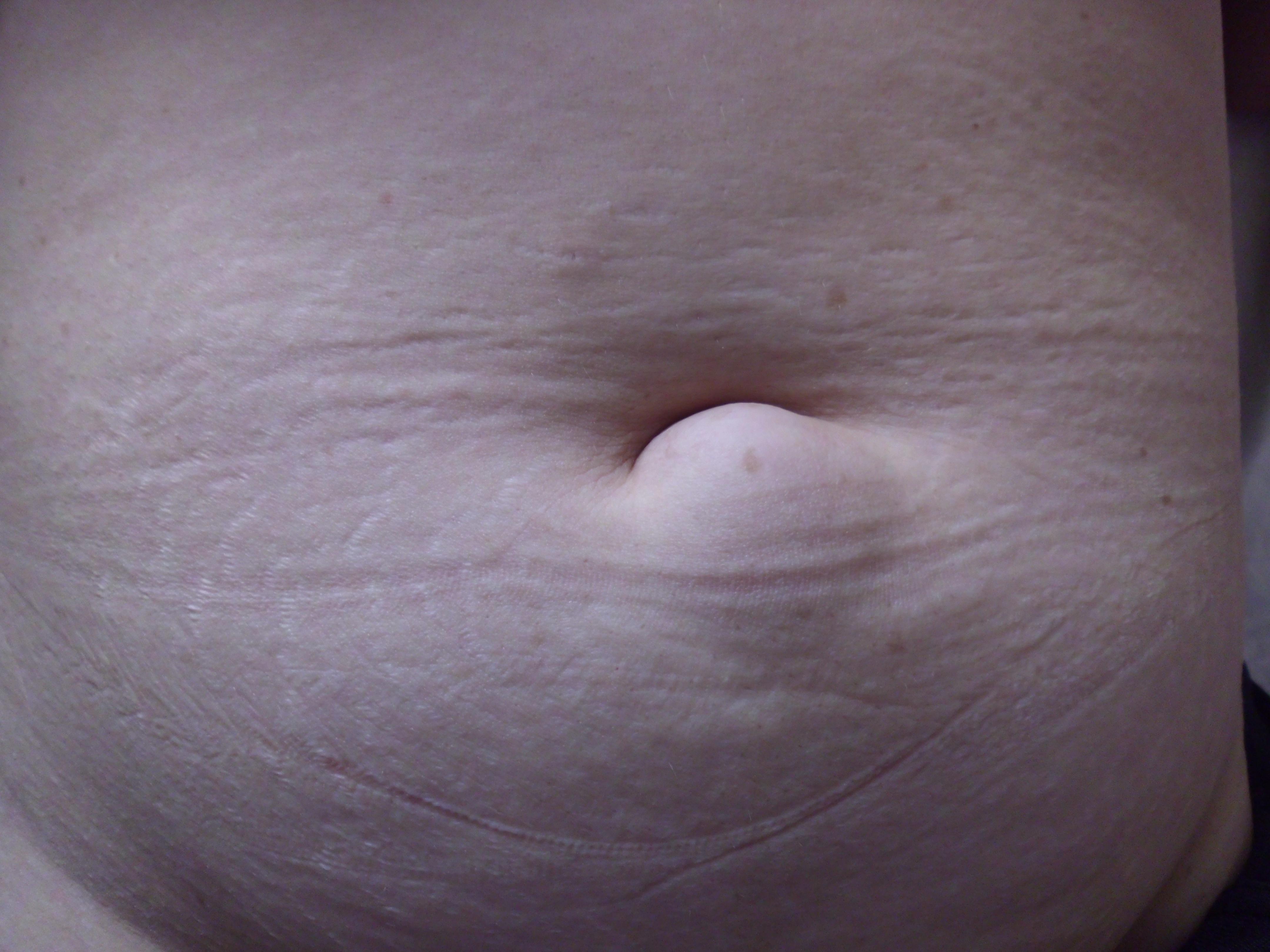 去外院检查超声提示皮下脂肪瘤  现在包块较以前逐渐增大且用力挤压也