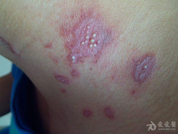 有点像带状疱疹啊,但病人说是被虫子咬了 虫咬性皮炎