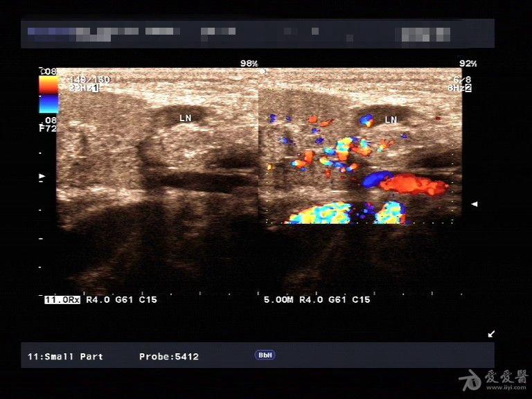 超声见:双侧颌下腺及右侧腮腺回声减低,不均匀并血流信号丰富.