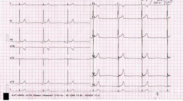 个人想法:这个心电图不是有p波么,为什么说是交界性心律?