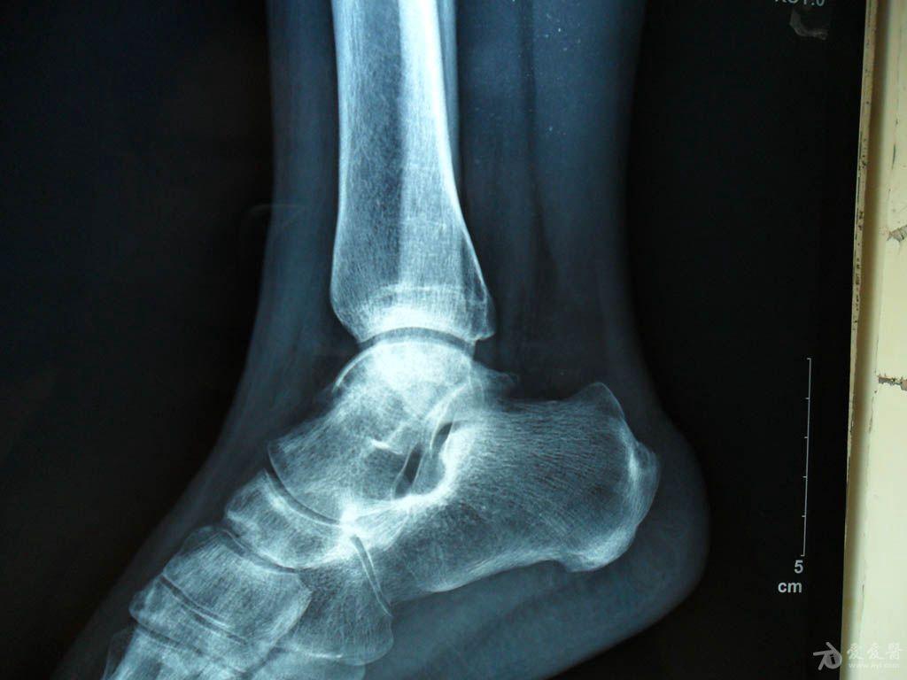 足踝外科成功实施3D打印距骨全表面置换手术，花季少女如愿步入大学|踝关节|活动度|距骨|外科|置换|手术|实施|花季|足踝|-健康界
