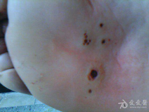 请问大师们,这是窝状角质松解症吗?