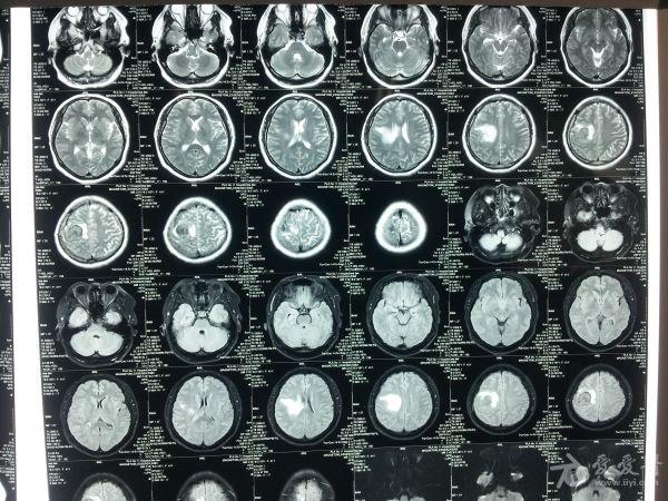 求助大家帮忙看着这个颅内占位该怎么诊断及治疗,谢谢
