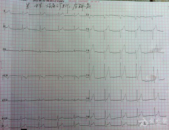 房性逸搏心律? - 心电图脑电图专业讨论版