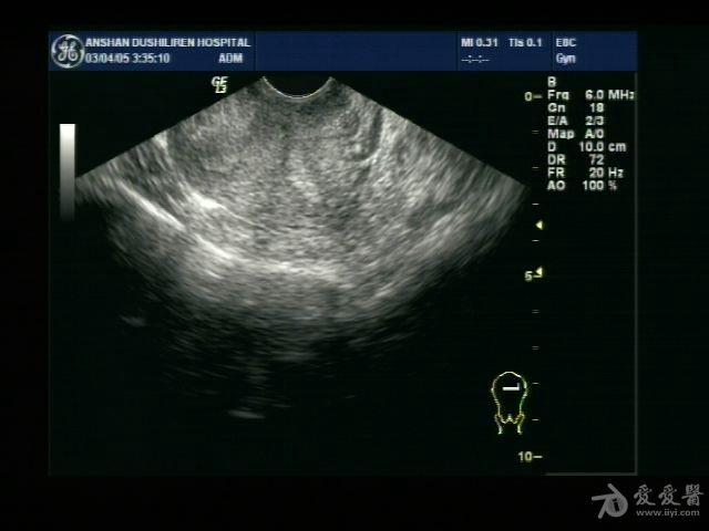 看看是双角子宫还是纵膈子宫 - 超声医学讨论版 - 医