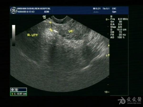 残角子宫? - 超声医学讨论版 - 爱爱医医学论坛-爱爱