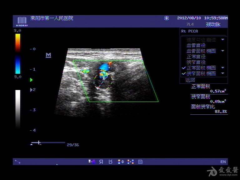 颈内动脉粥样硬化斑块形成伴狭窄 - 超声医学讨论版