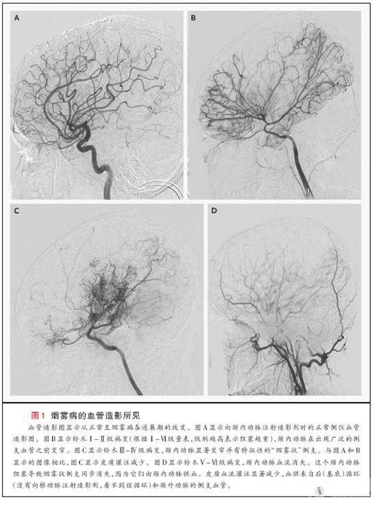 烟雾病和烟雾综合征