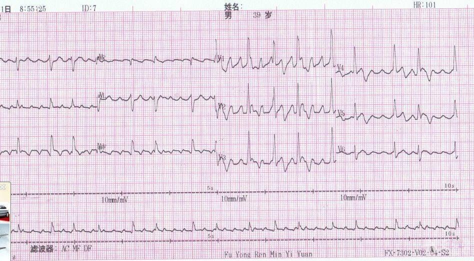 房扑,房颤 心电图脑电图专业讨论版 爱爱医医学论坛 爱爱医医学