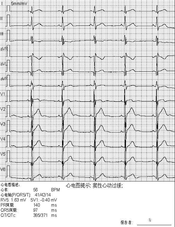 这份图算不算不完右 - 心电图脑电图专业讨论版 - 医