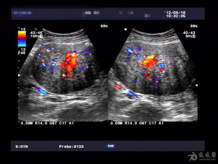 典型病例—子宫腺肌症(一 超声医学讨论版 爱爱医医学论坛