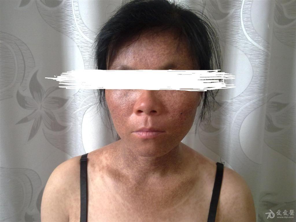 【超级难】全身皮肤逐渐发黑,请高人指点!(请大家关注此病例--良斑8.