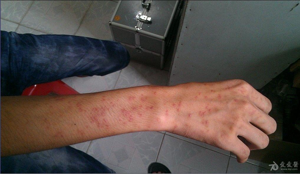 湿疹?日光性皮炎?马拉色毛囊炎?
