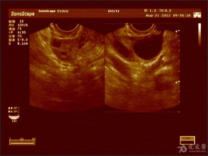 残角子宫 - 超声医学讨论版 - 爱爱医医学论坛 - 爱爱