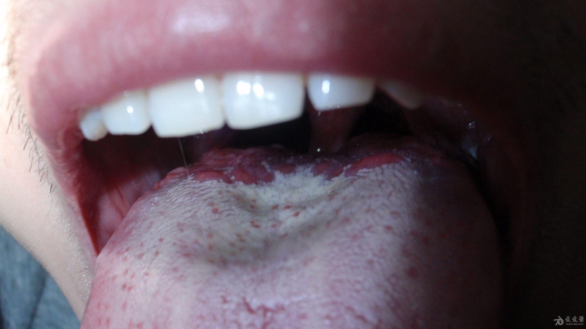 舌头侧面溃疡,舌根两侧有疙瘩图片 - 伤感说说吧
