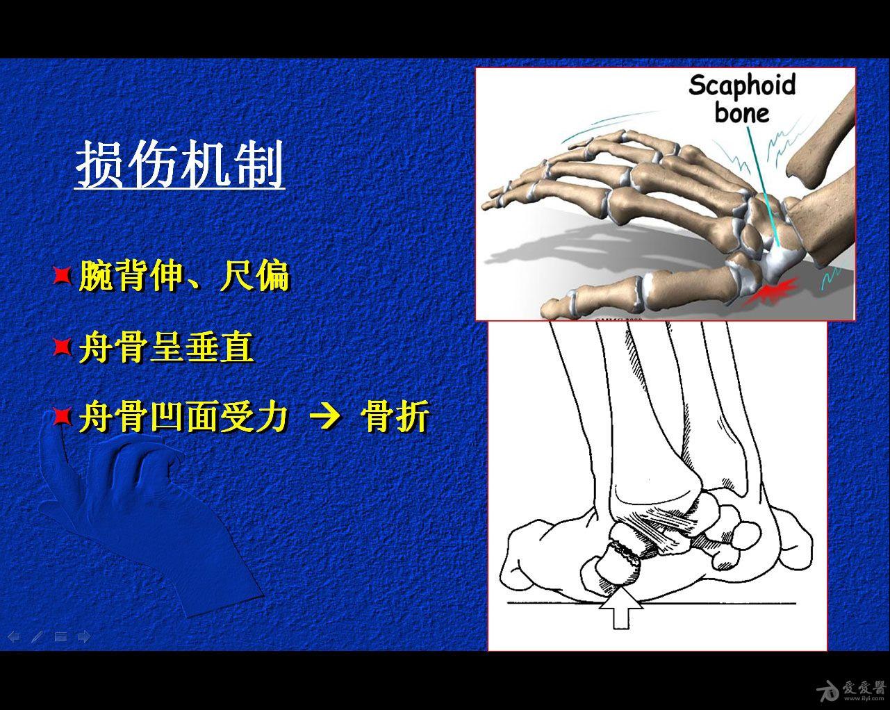 闭合复位经皮埋头空心螺钉 治疗腕舟骨骨折【50期读片会】