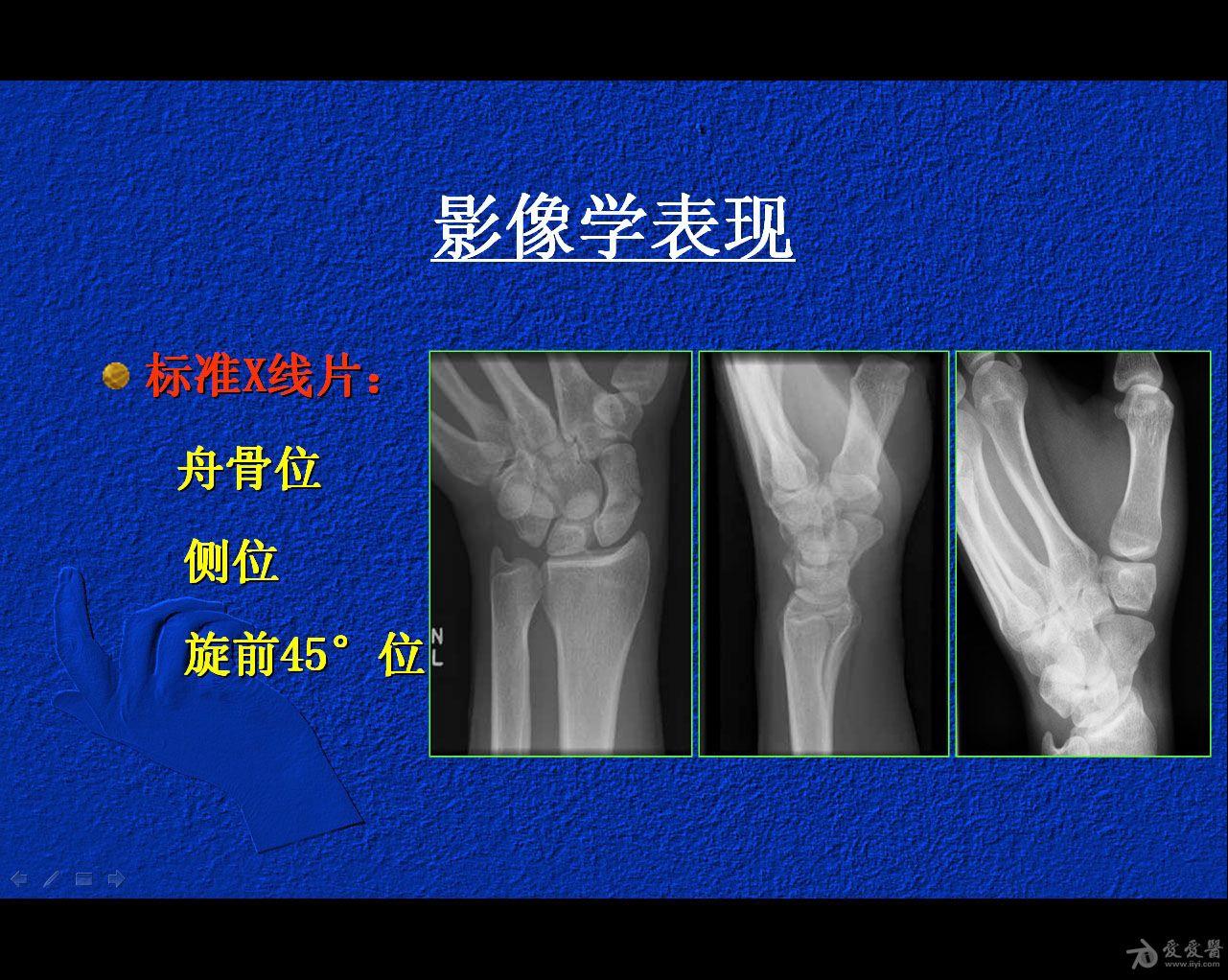 闭合复位经皮埋头空心螺钉 治疗腕舟骨骨折【50期读片